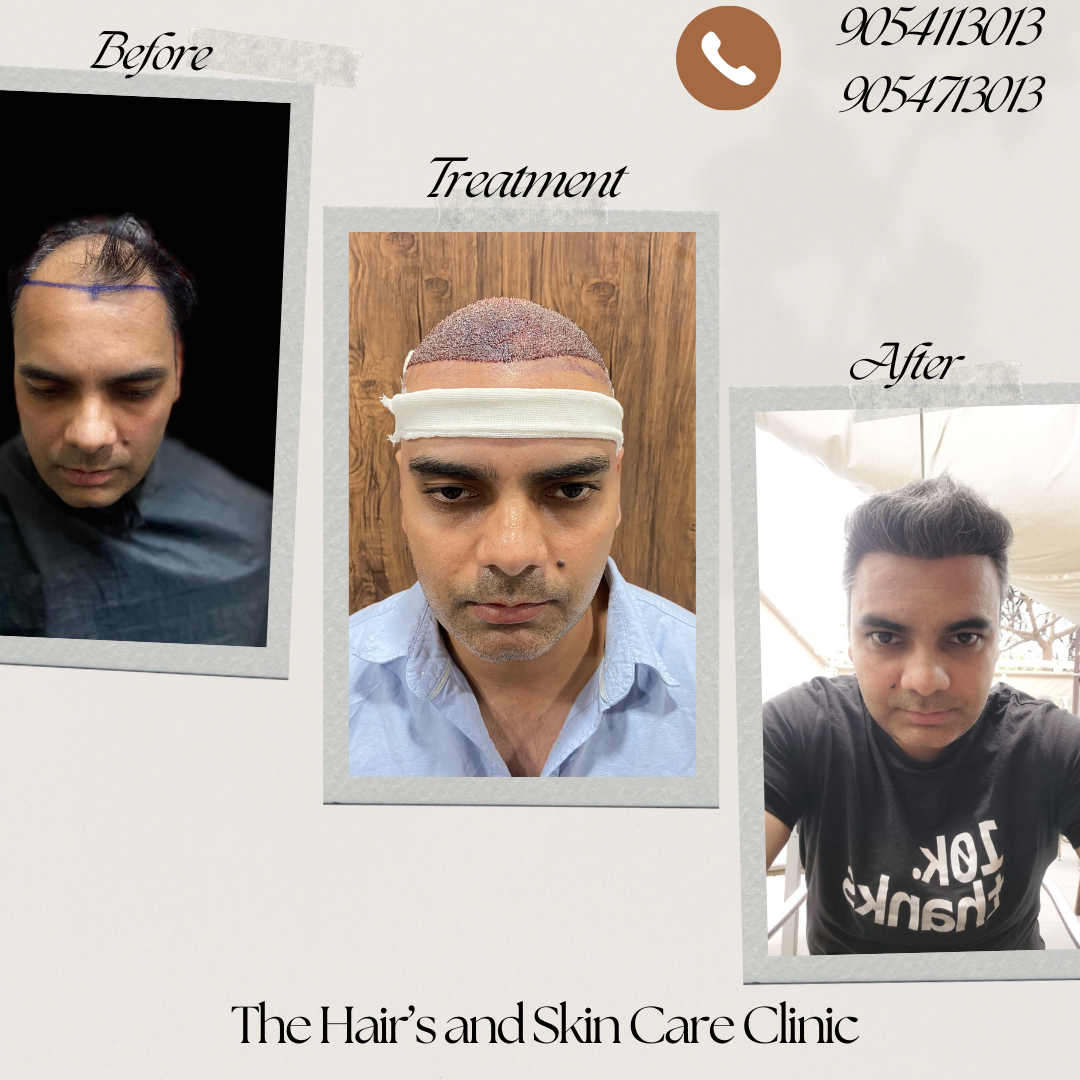 Hair Transplant Best Results