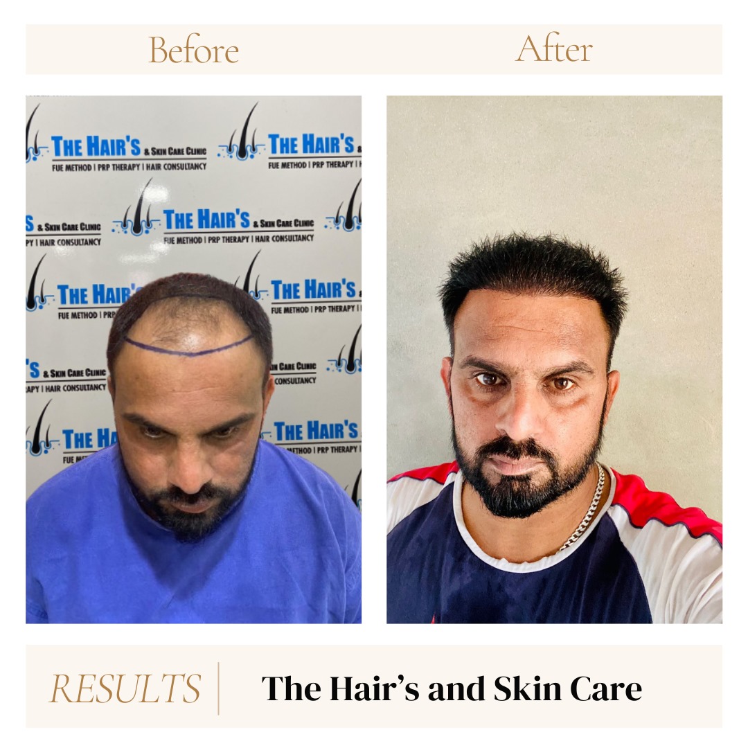 Hair Transplant Best Results