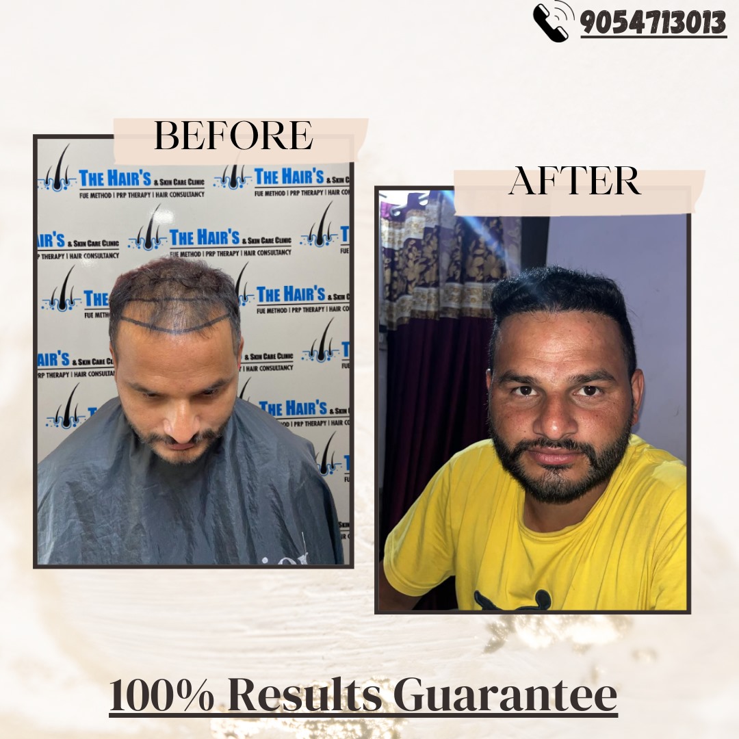 Best Hair Transplant in Jalandhar