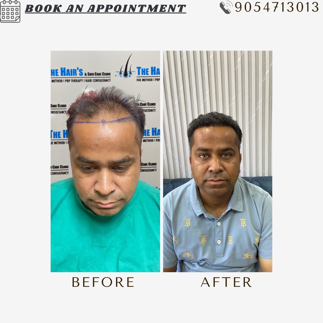 Hair Transplant Best Results