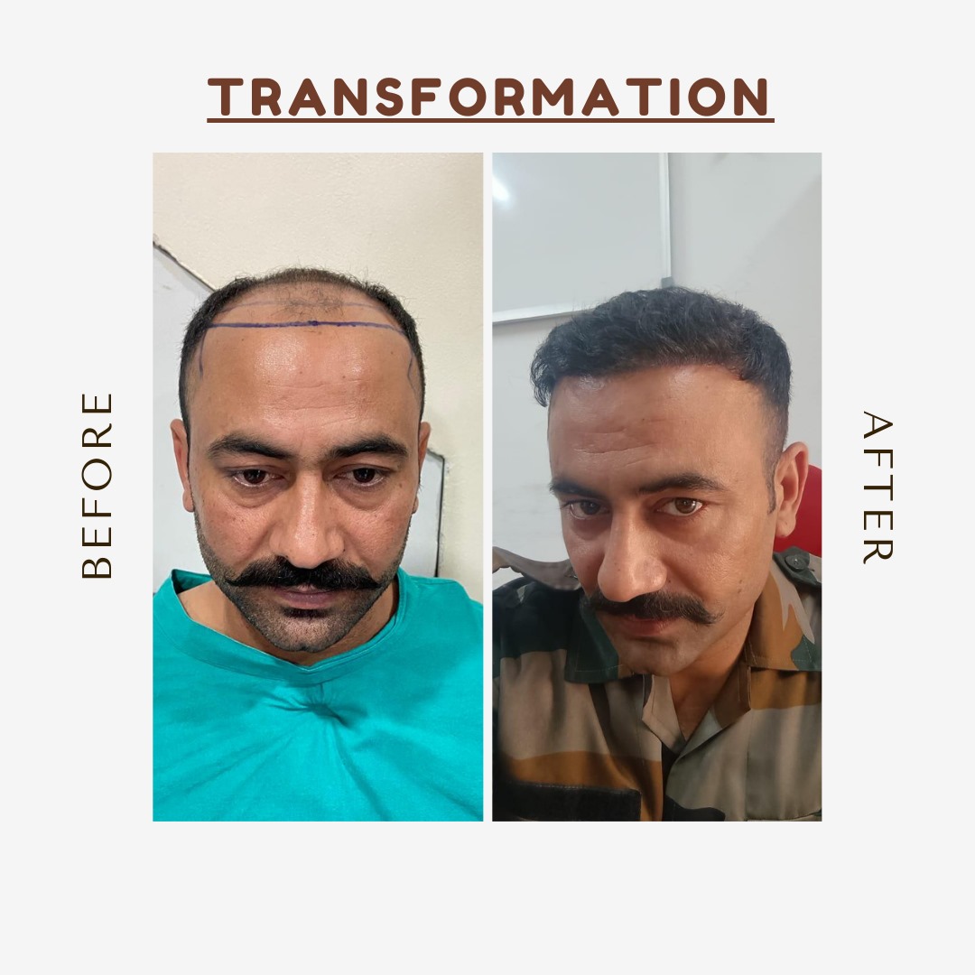 Hair Restoration Procedure in Jalandhar Punjab