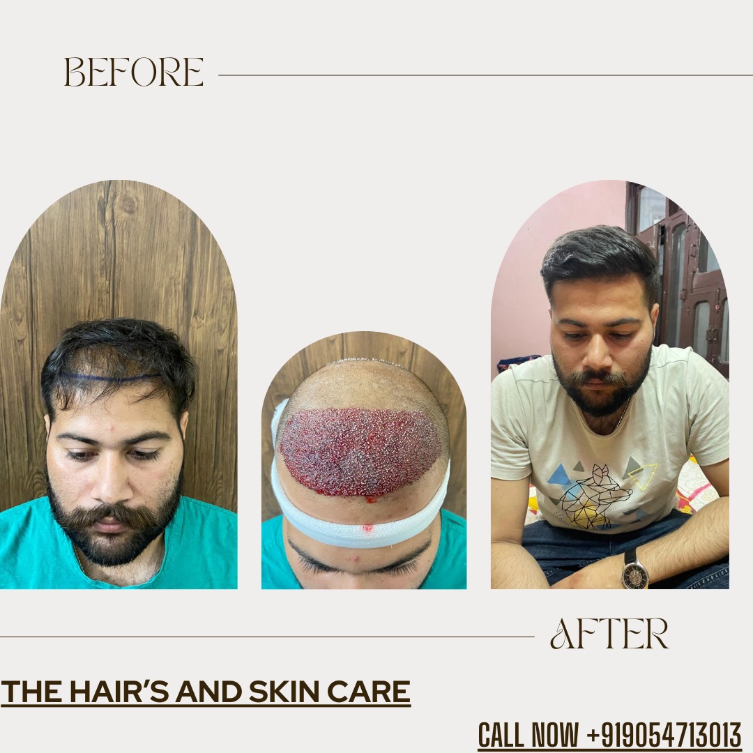 Hair Transplant Best Results