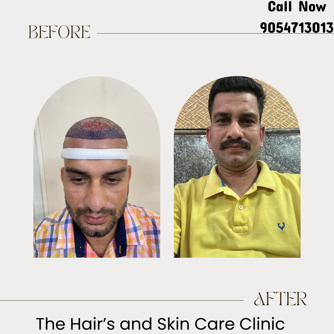 Hair Transplant Best Results