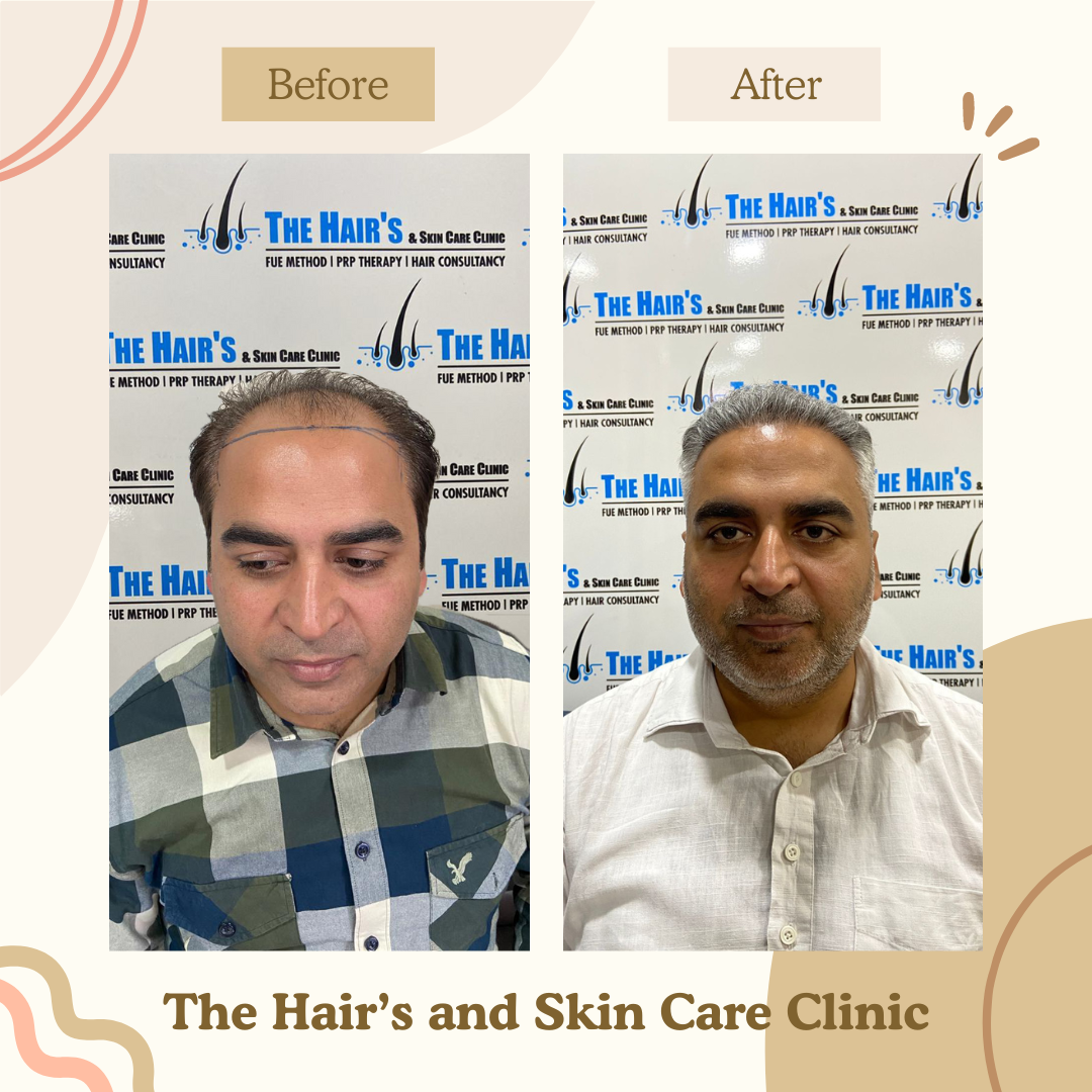 hair transplant best result