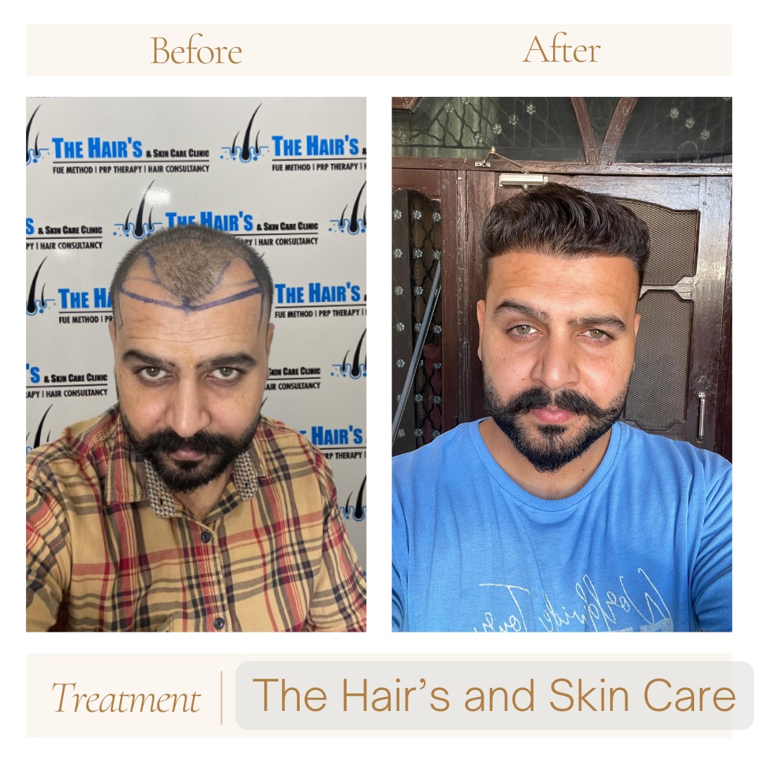 hair transplant best result