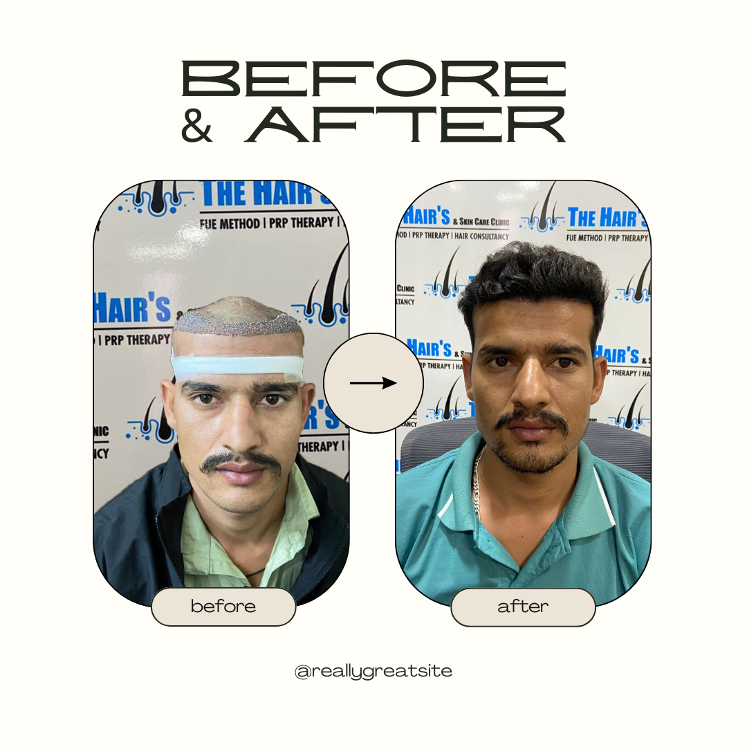 hair transplant best result